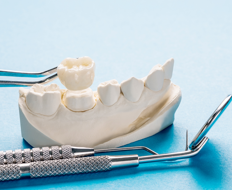 Установка зубных коронок: как это происходит?